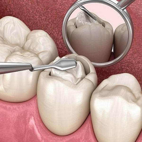 Are Dental Fillings Safe? Addressing Common Concerns