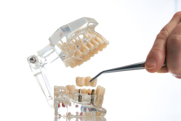 E-Max Veneers in Riyadh: A Smile That Lasts a Lifetime