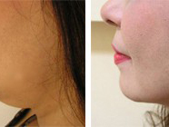 Chin Liposuction FAQs: Addressing Common Concerns