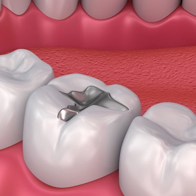 The Role of Dental Fillings in Preventing Cavities