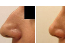 Revision Rhinoplasty: Correcting or Enhancing a Previous Nose Job