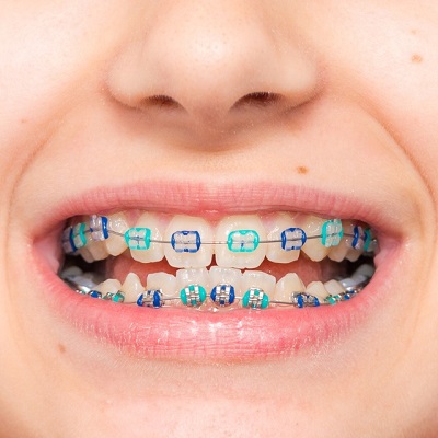 Understanding the Different Types of Dental Braces