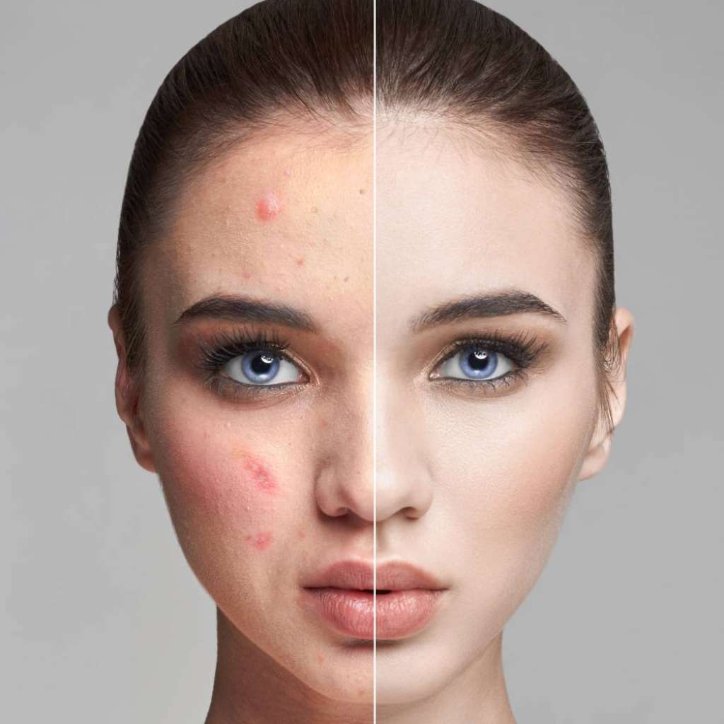 Achieving a Flawless Complexion: Top Acne Scar Treatments Available in Dubai