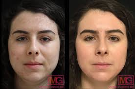 Subcision Near Me: A Revolutionary Treatment for Acne Scars