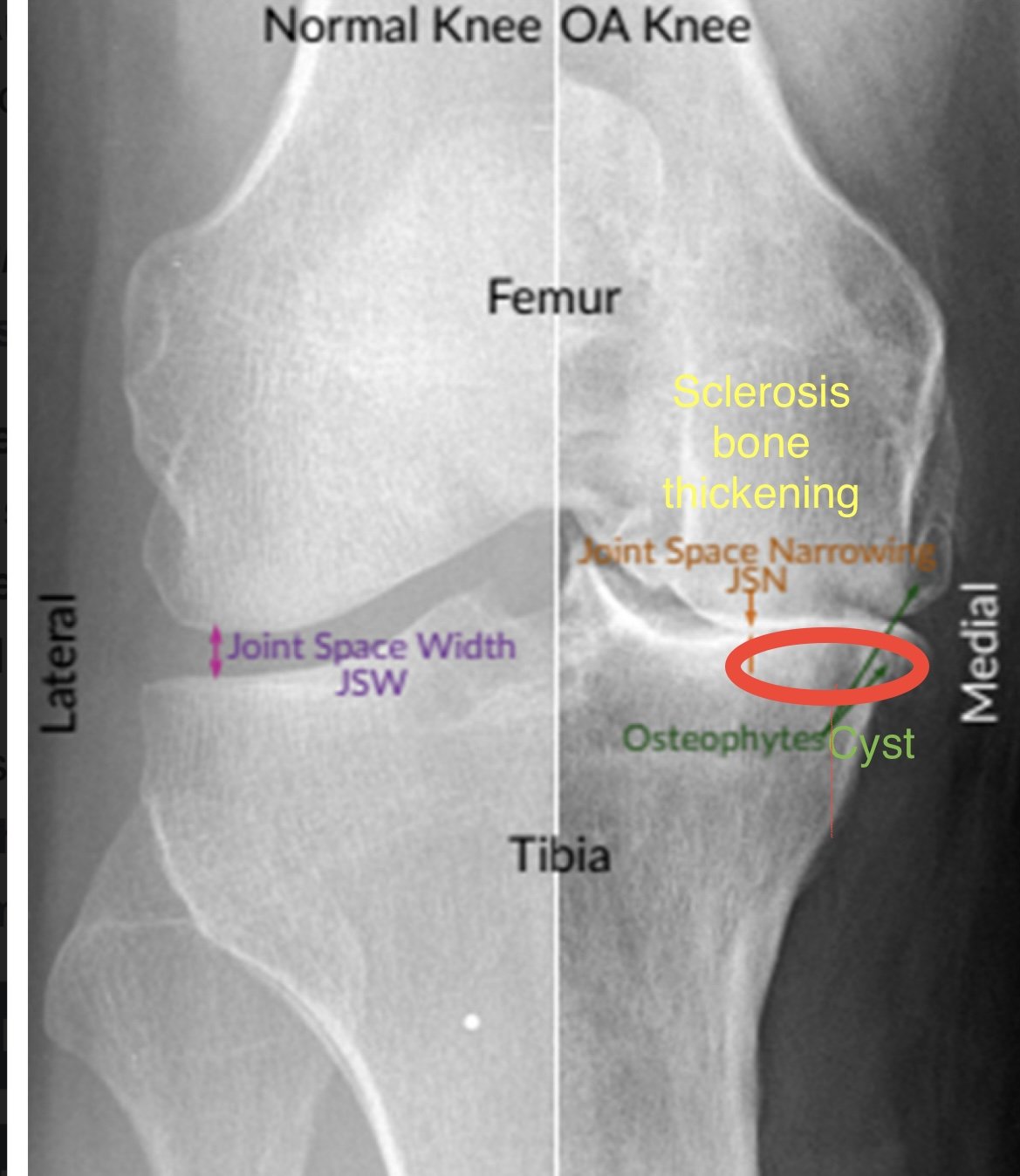 Understanding Knee Osteoarthritis in London: A Comprehensive Guide