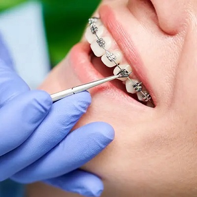 How Orthodontists Treat Crossbites: A Comprehensive Guide