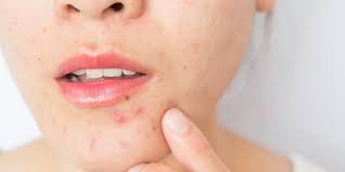 Healthy Skin, Happy You: Effective Acne Treatment Tips