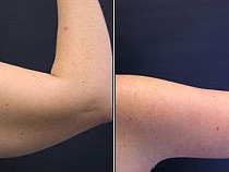 Can You Combine an Arm Lift with Other Cosmetic Procedures?