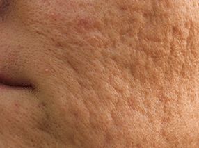Clear Skin with These Proven Milia Treatments