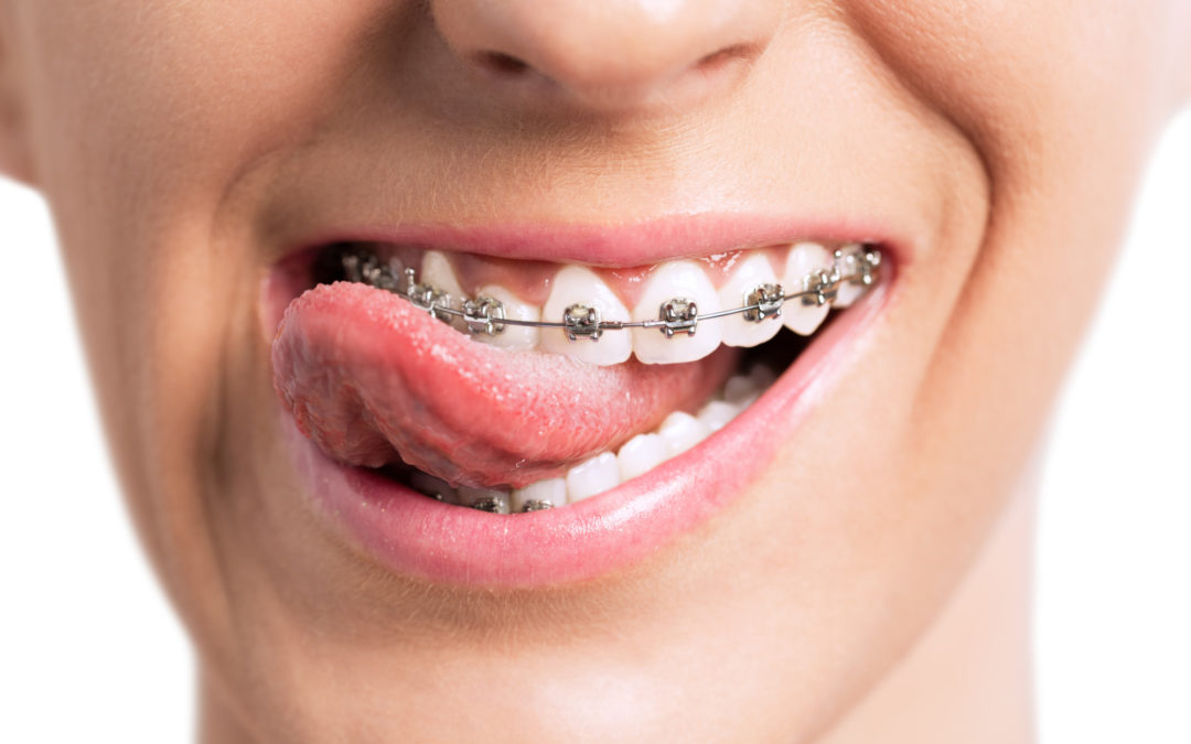 Metal Braces: The Classic Choice for Orthodontics
