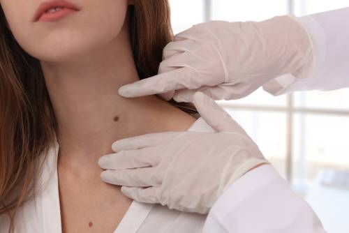 The truth about skin tag removal creams