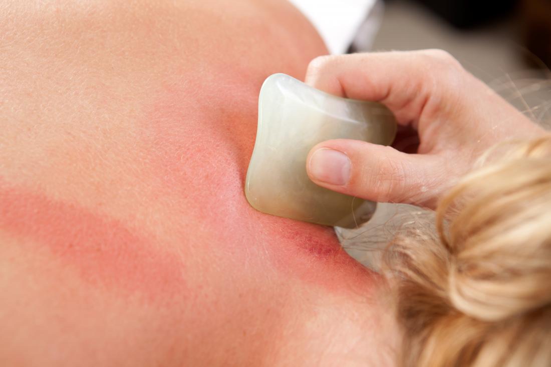 How Guasha Therapy for Stress Relief in Burlington is beneficial for body?