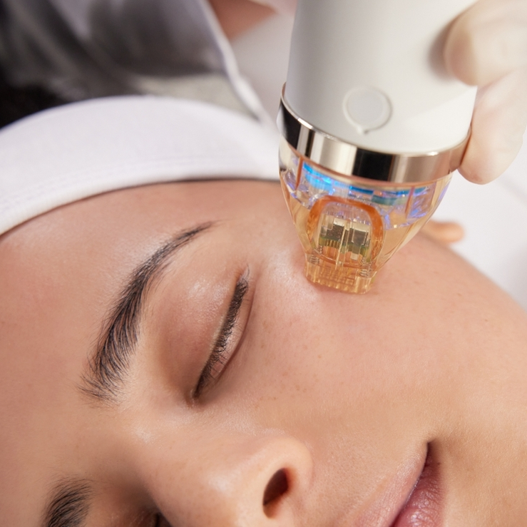 Microneedling for Firm, Smooth, and Glowing Skin