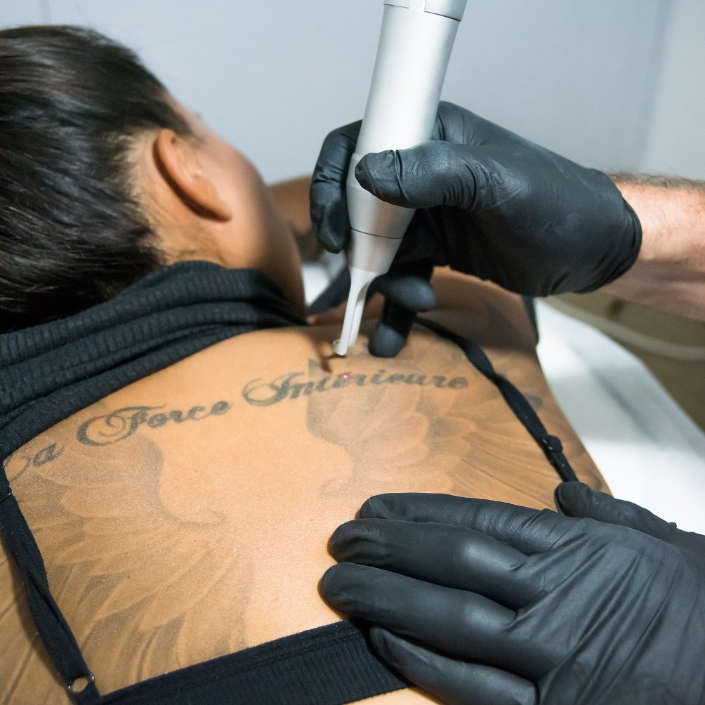 Remove Tattoos with Expert Laser Tattoo Removal Care