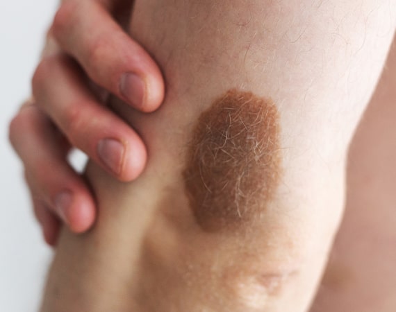 Uncover Your True Skin: Birthmark Removal Revealed