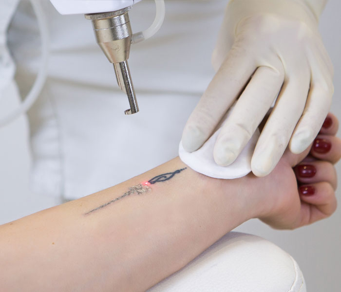 Is Laser Tattoo Removal Safe for Sensitive Skin?