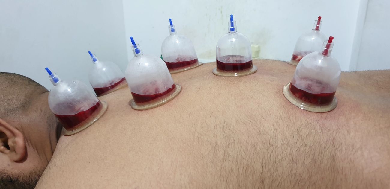 Hijama: The Key to Pain Relief and Recovery