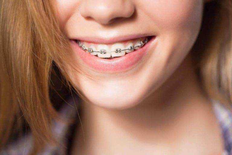 Metal Braces: The Key to a Beautiful Smile
