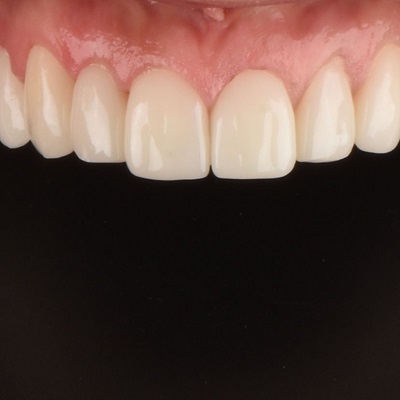 How Digital Smile Design Can Help with Gummy Smiles