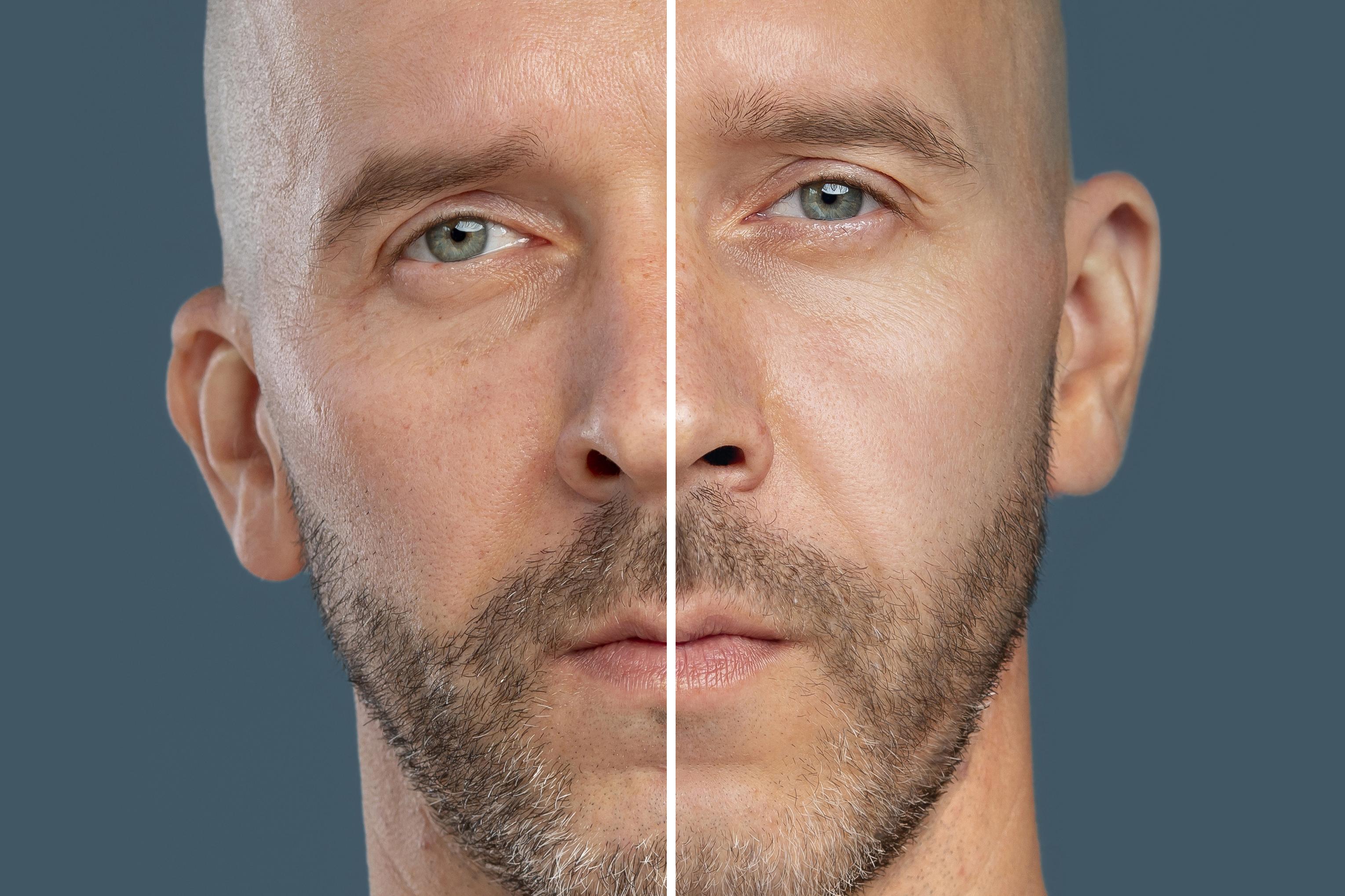 Ultherapy vs. Morpheus8: Which Skin Tightening Treatment Is Right for You?