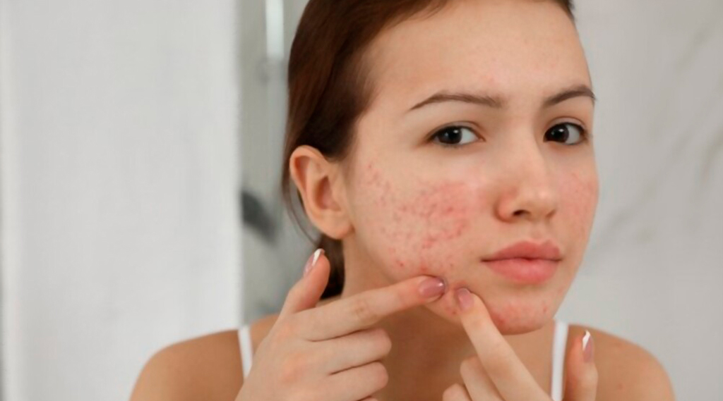 Acne Treatment Strategies: Finding the Right Solution for You
