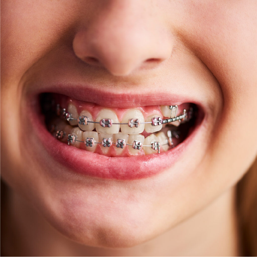 Metal Braces: A Smart Investment in Your Smile