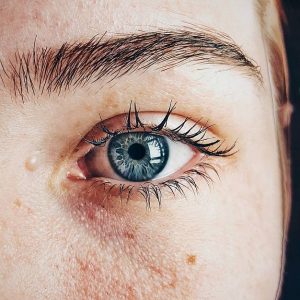 Skin Tag Removal: Affordable and Effective