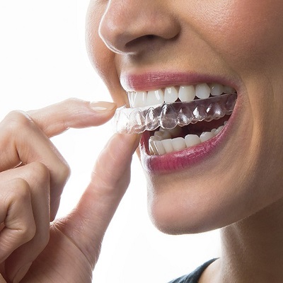 Are Clear Aligners Safe? Addressing Common Concerns and Misconceptions