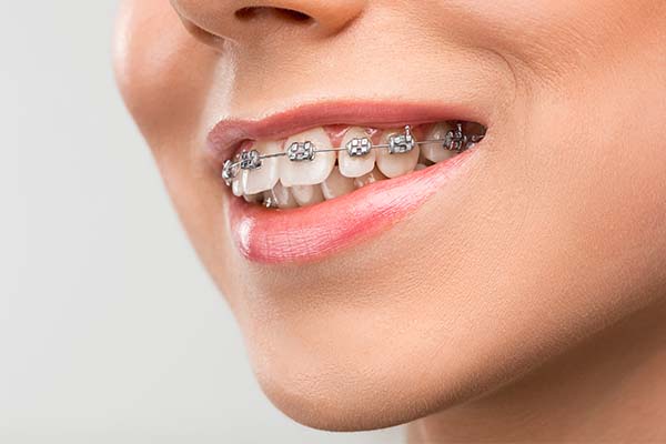 Get Ready for a Smile Makeover with Metal Braces