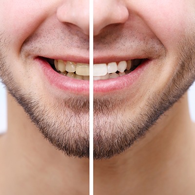 What Results Can You Expect from Zoom Teeth Whitening?