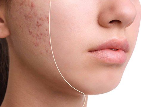 Achieve Flawless Skin with Subcision Treatment for Acne Scars
