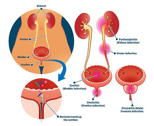 How Can You Tell If Your Child Has a Urinary Tract Infection?