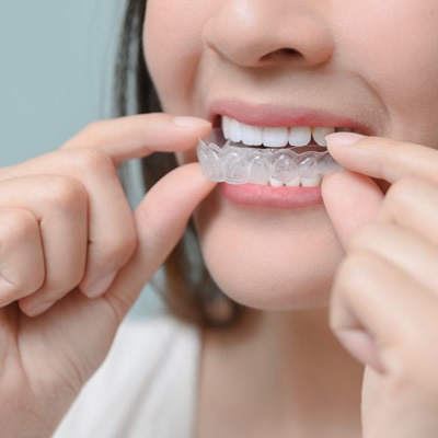 Are There Alternatives to Braces for Treating Overlapping Teeth?