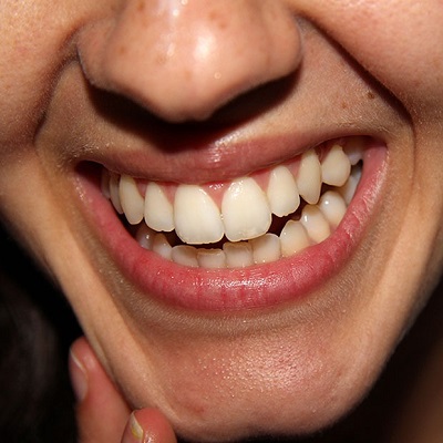 Overlapping Teeth: A Comprehensive Guide to Treatment Options