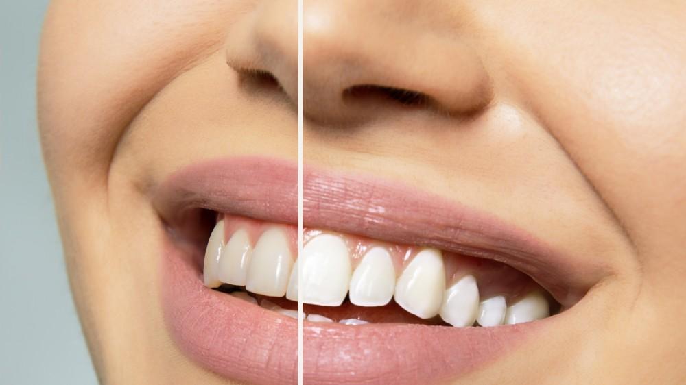 Teeth Whitening and Oral Health: What You Need to Consider