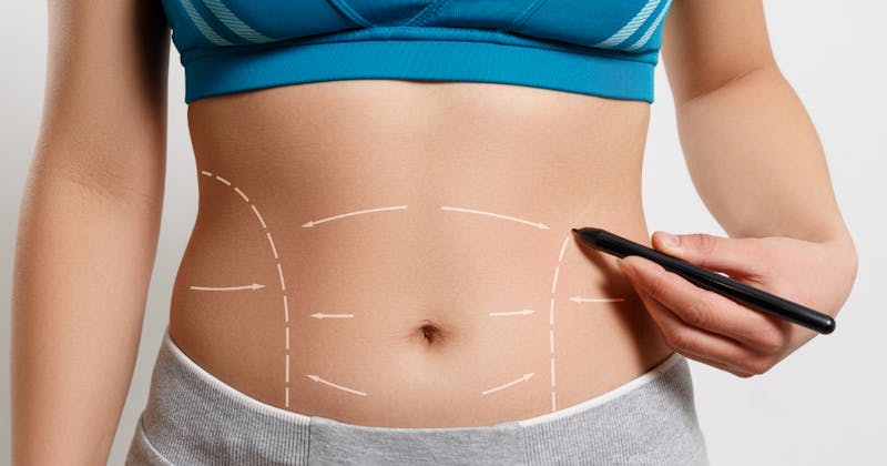 Tummy Tuck vs. Liposuction: Which Is Better?