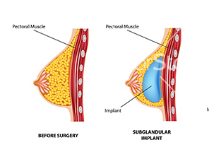 Real Patient Stories: Best Breast Augmentation Experiences and Outcomes