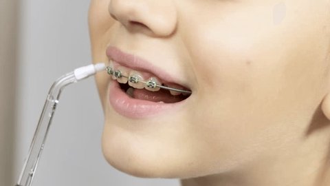 Aligning Your Journey: The Process of Getting Teeth Braces