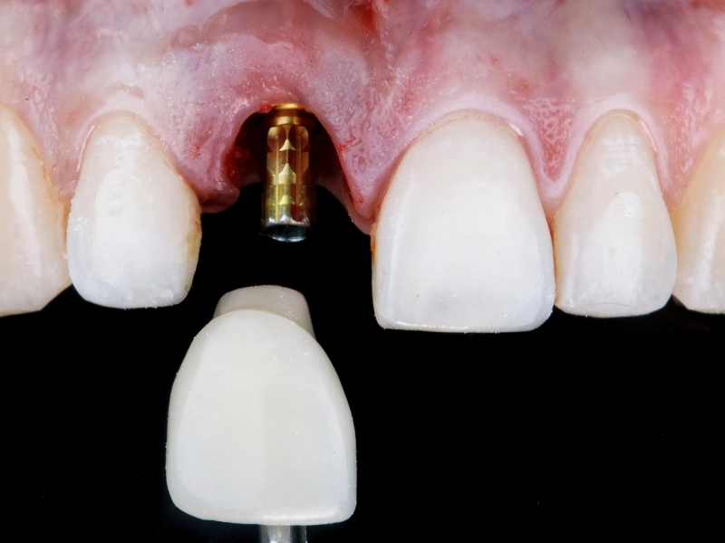 Innovations in Dental Implant Technology: What’s New?
