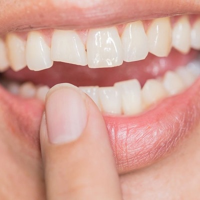 The Importance of Nighttime Routines in Managing Teeth Grinding