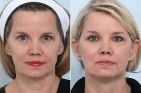 Ultherapy vs. Morpheus8: Choosing the Best Skin Tightening Treatment for You