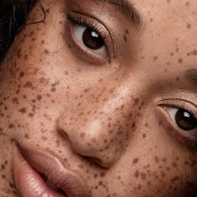 Say Goodbye to Dark Spots: Dermal Pigmentation Treatments in Islamabad