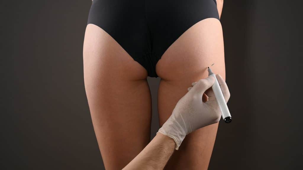 Buttock Augmentation Surgery: Transforming Bodies, Building Confidence