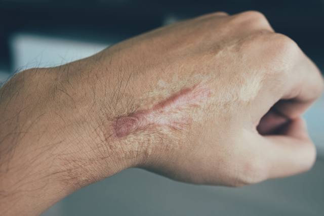 Enhancing Function and Aesthetics with Burn Surgery