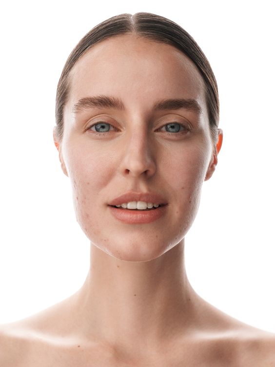 How can I prevent future acne scars?