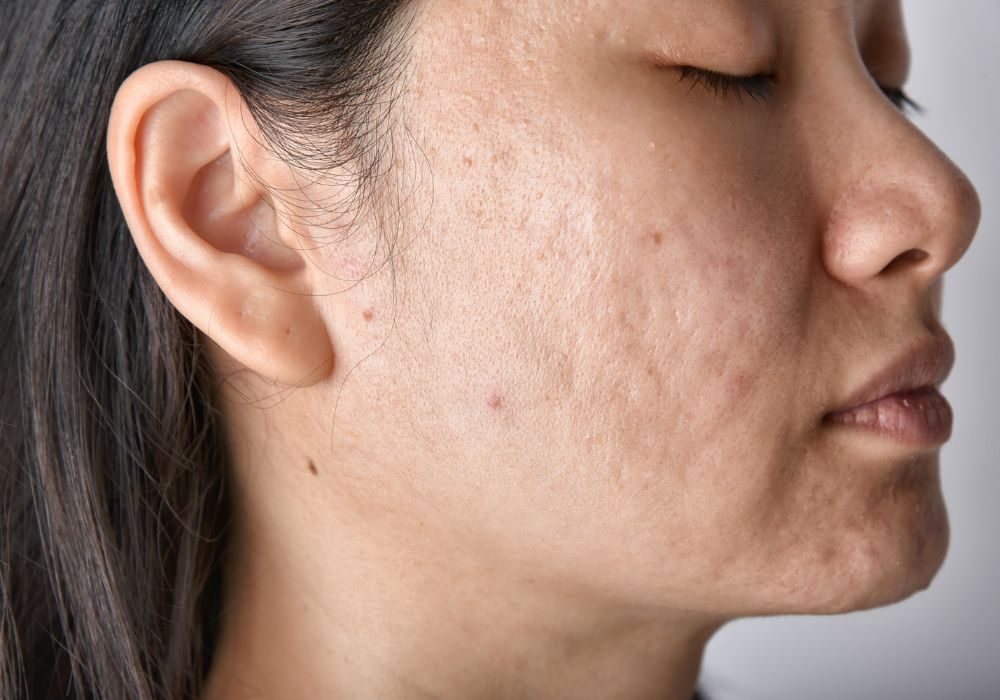 What to Expect During a Pimples Treatment