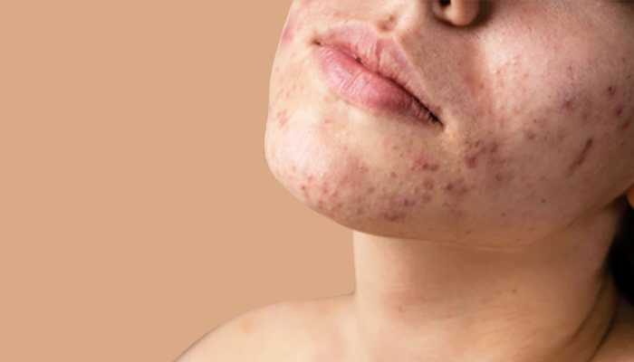 How to Choose the Right Treatment for Your Pimples
