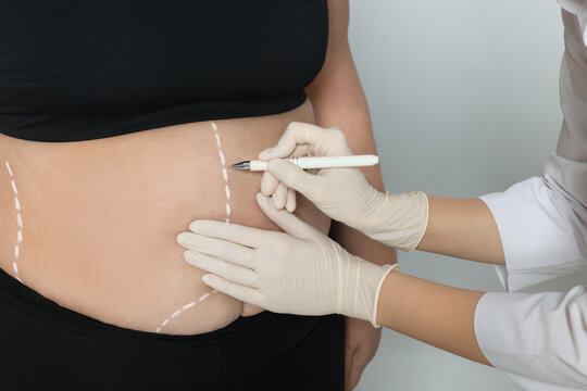 The Hidden Risks of Bariatric Surgery: What You Need to Know Before Going Under the Knife