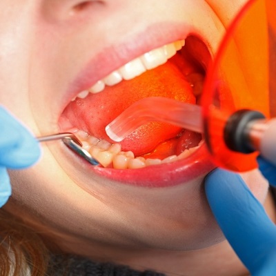 Pros and Cons of Cosmetic Dentistry for Teenagers