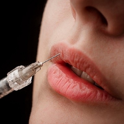How Long Do Lip Fillers Last in Islamabad?